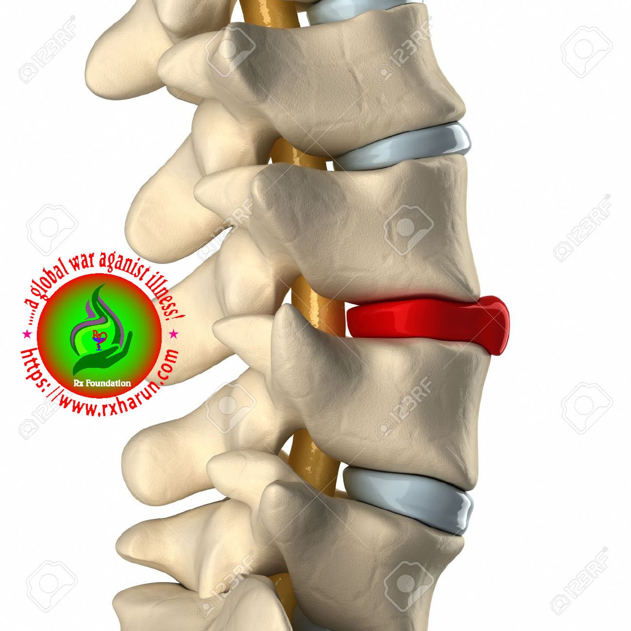 spondylolisthesis