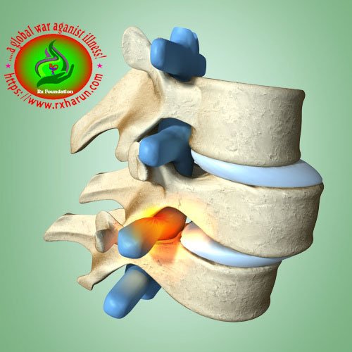 spondylolisthesis