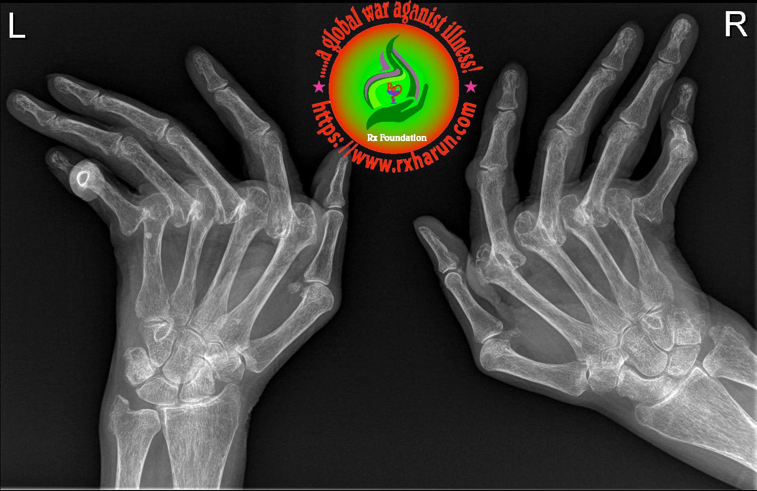 psoriatic arthritiss-treatment of british society 