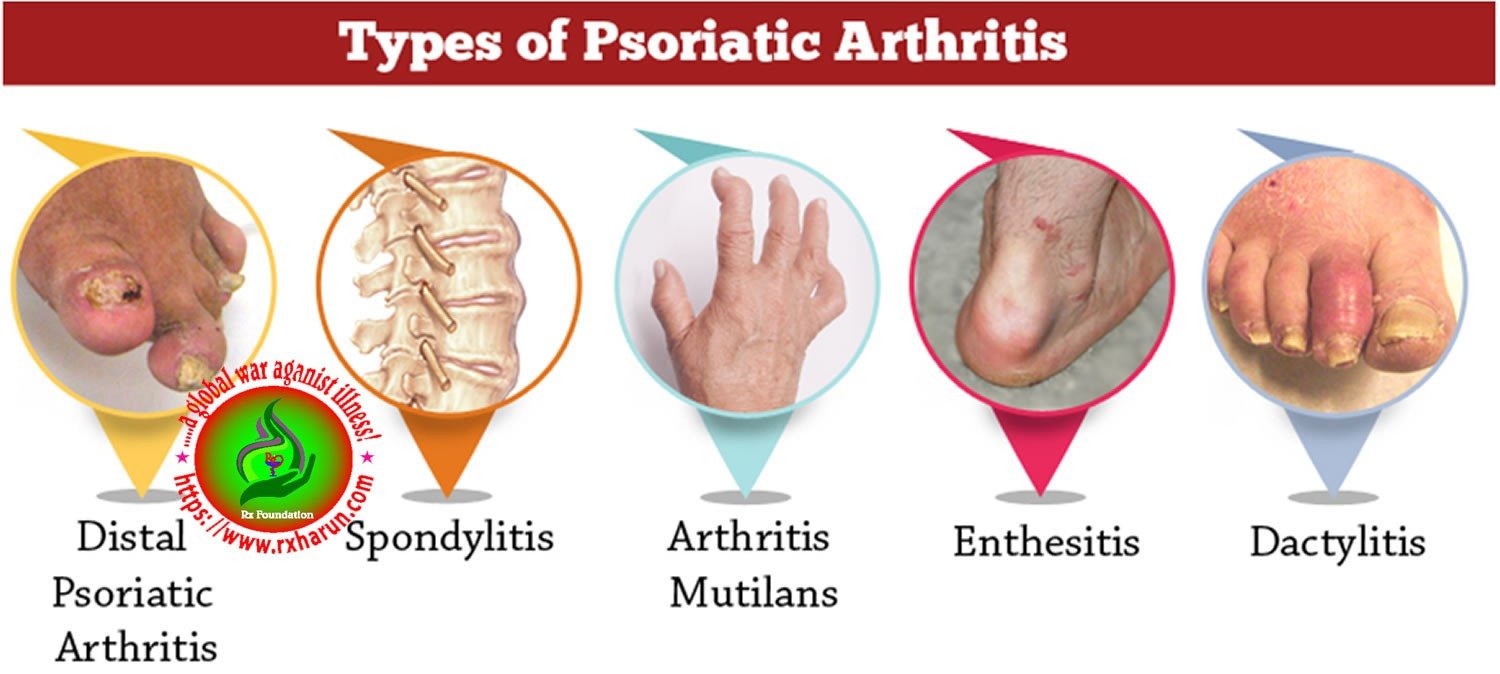 psoriatic arthritis-classification