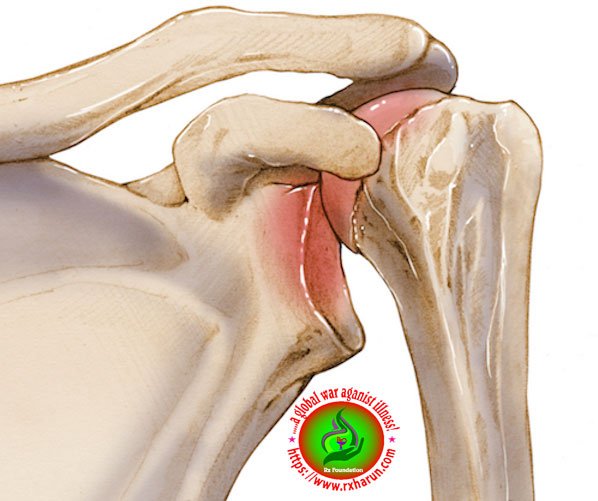 inferior Dislocation