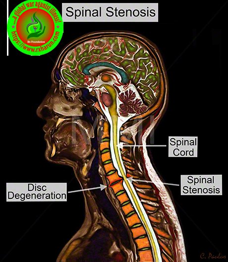 Cervical spondylosis