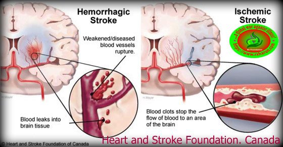 rxharun.com/stroke/anti-platelate