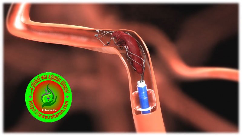 rxharun.com/stroke-lifestyle/acu_stroke