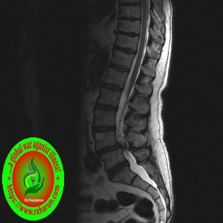 rxharun.com/ankylosing spondilities