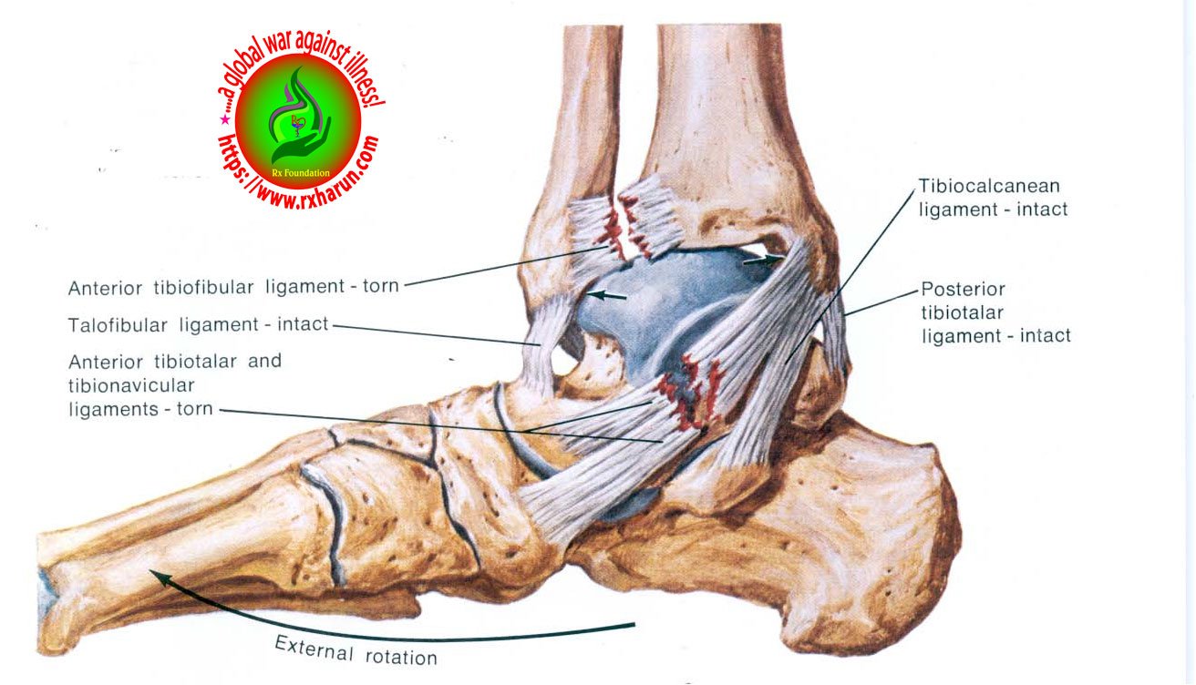 Foot  Sprain, Strain