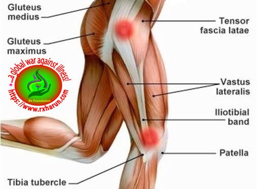 Iliotibial Band Syndrome