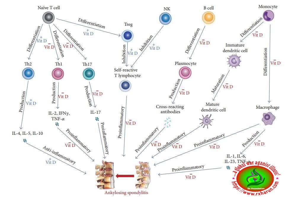 Ankylosing Spondylitis
