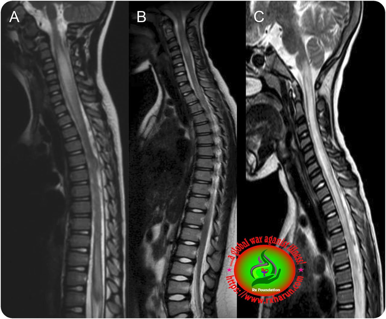 Transverse Myelitis 