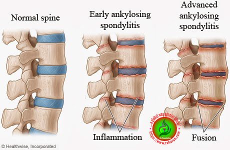 Ankylosing Spondylitis