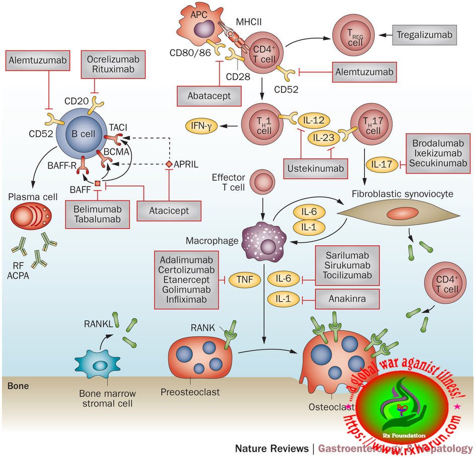 Ankylosing Spondylitis