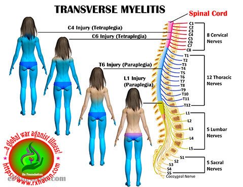 Transverse Myelitis 