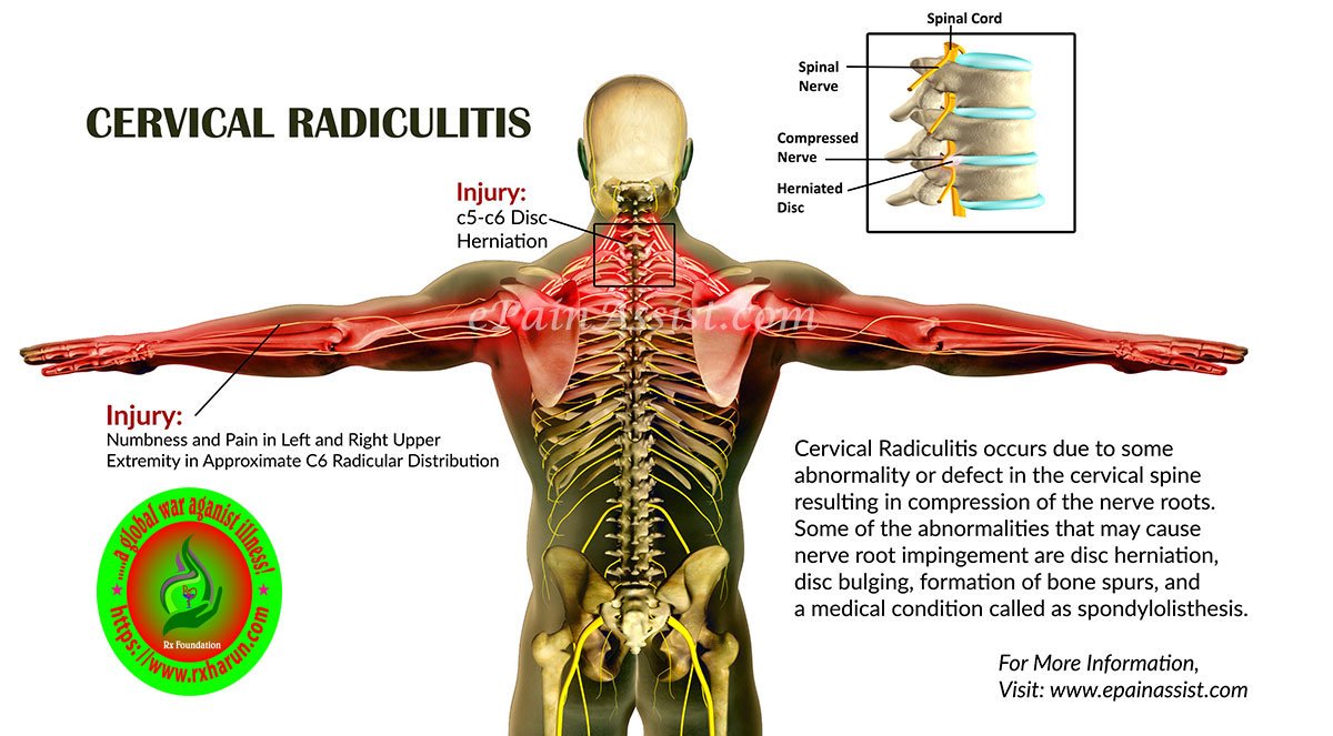 https://illnesshacker.com/2017/11/18/cervical-myelopathy-and-spinal-cord-compression/cervical-radiculitis-popup/