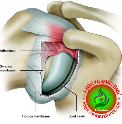 rxharun.com/frozen-_shoulder