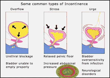 rxharun.com/urinary incontinence