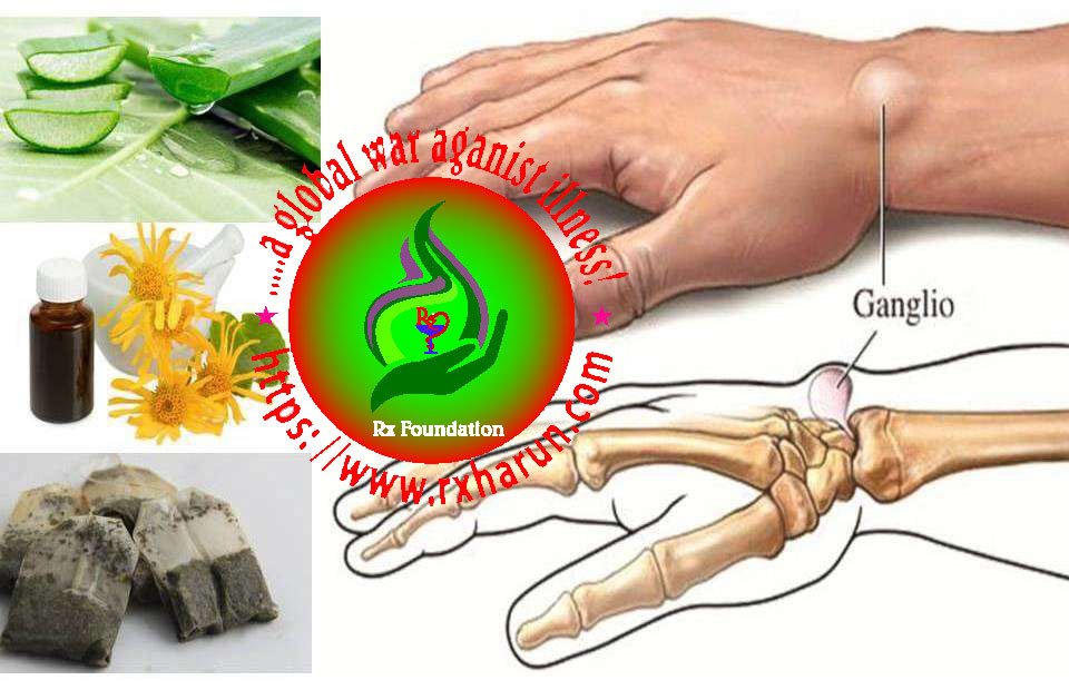 rxharun.com/ganglion cyst