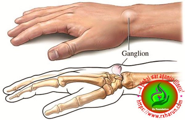 rxharun.com/ganglion cyst