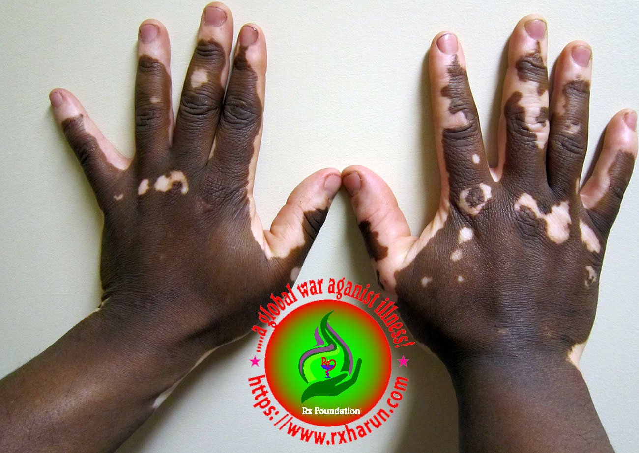 Vitiligo