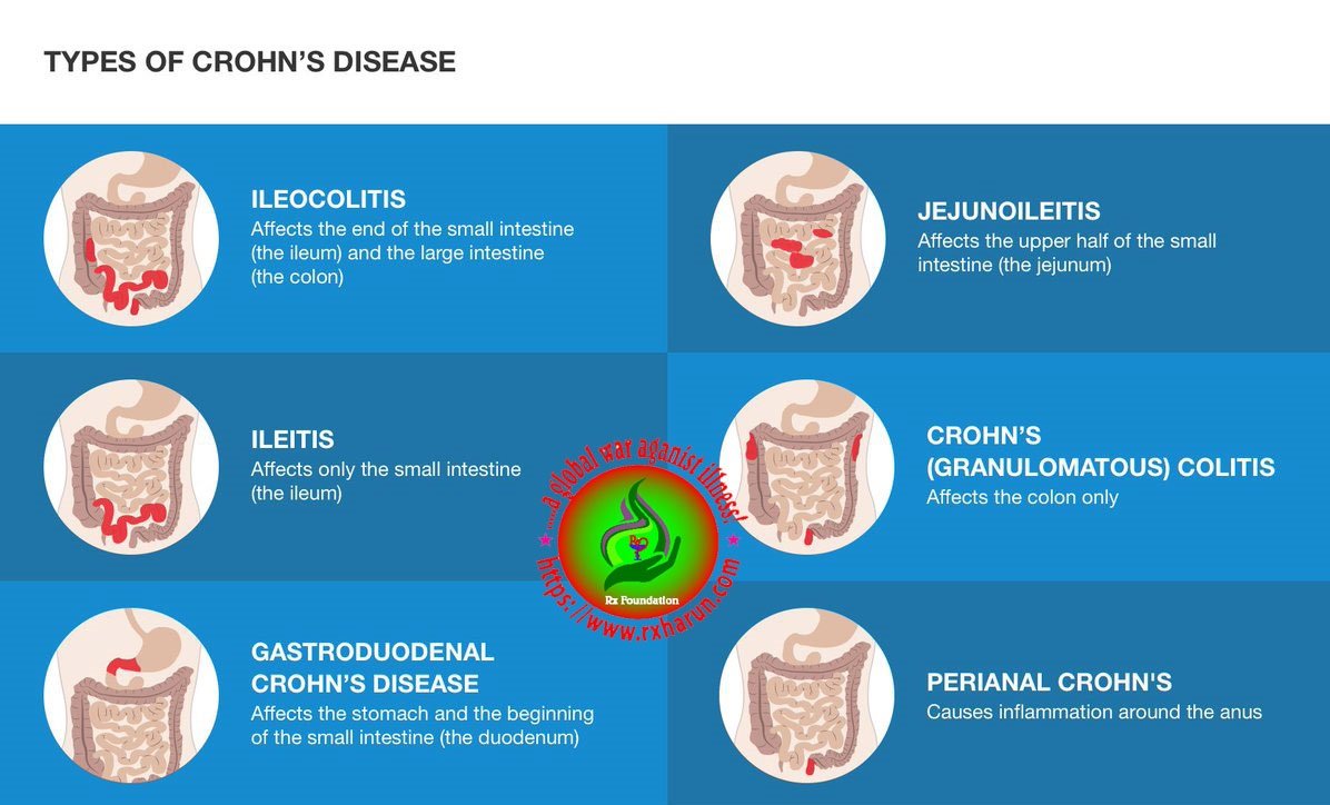 Crohn's disease