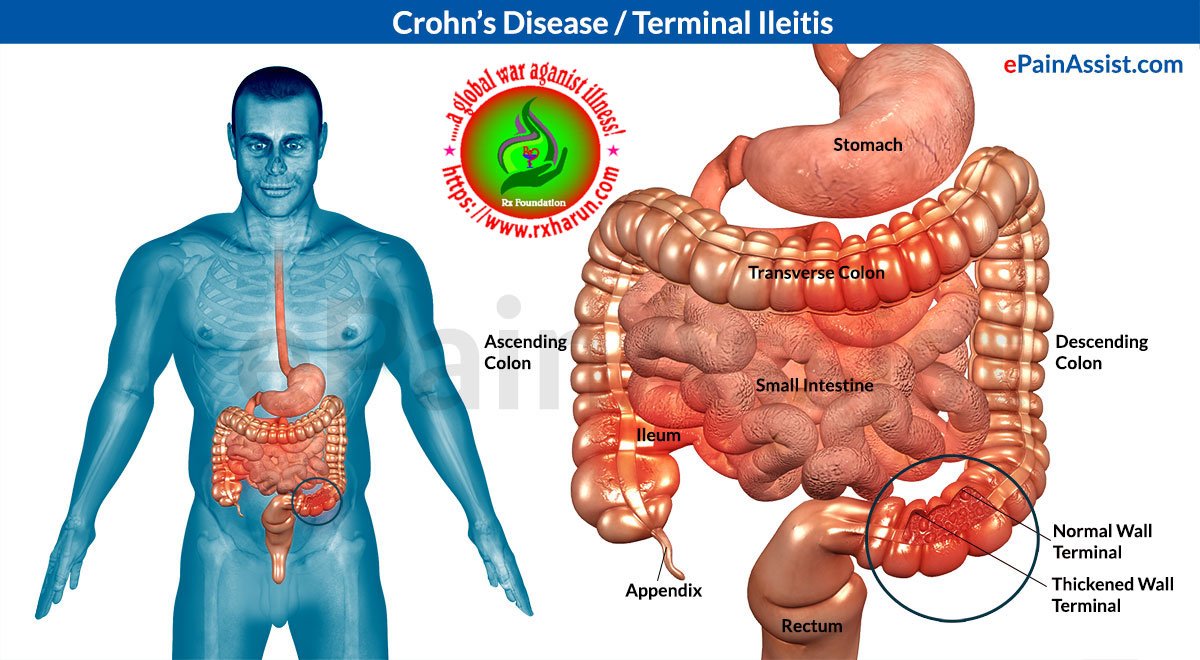 Crohn's disease