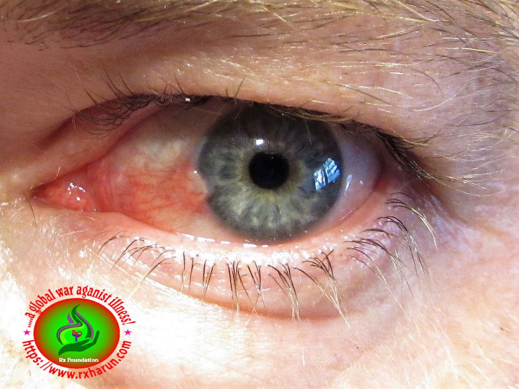 eye diseases Pinguecula