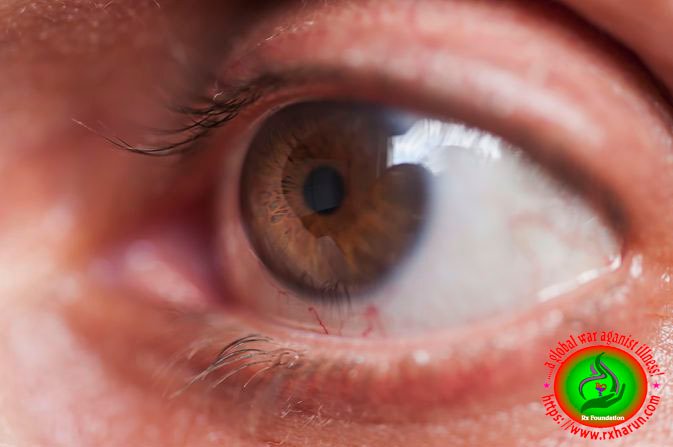 eye diseases Glaucoma