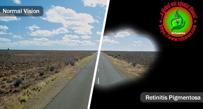 eye diseases, CMV Retinitis