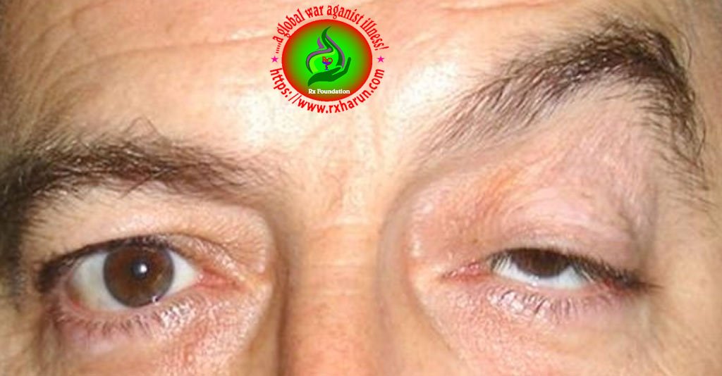 eye diseases Ptosis