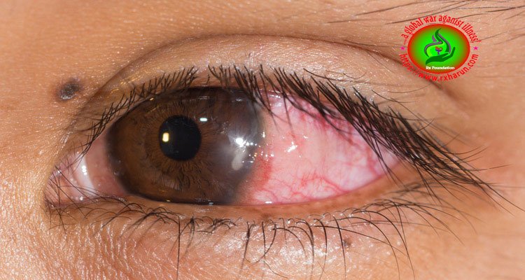 eye diseases, Corneal Ulcer