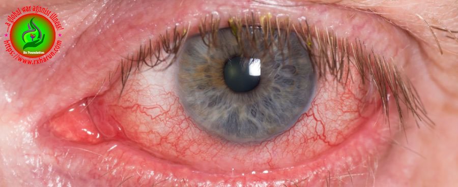 eye diseases Eye Occlusions
