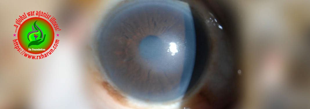 eye diseases,Fuchs' Corneal Dystrophy 