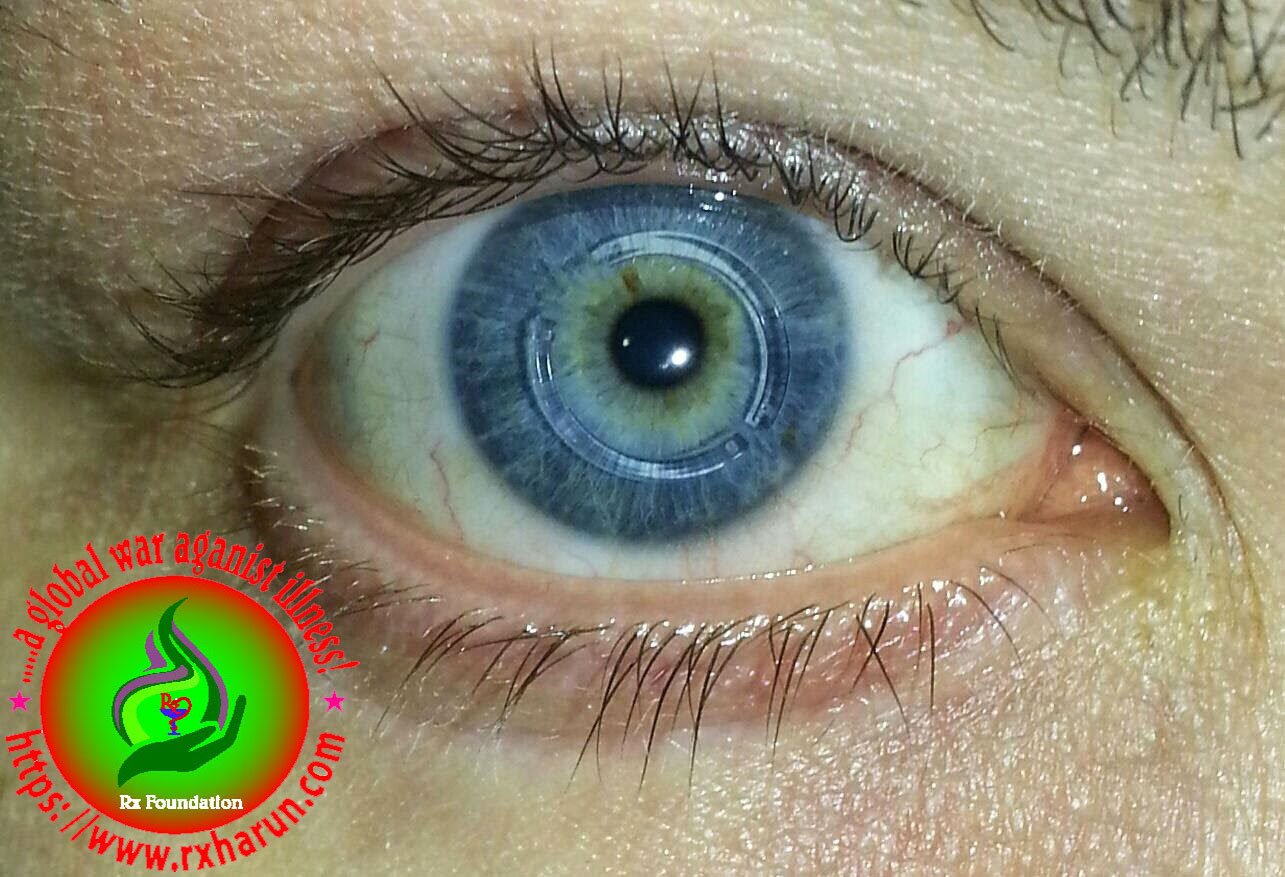 eye diseases -Keratoconus