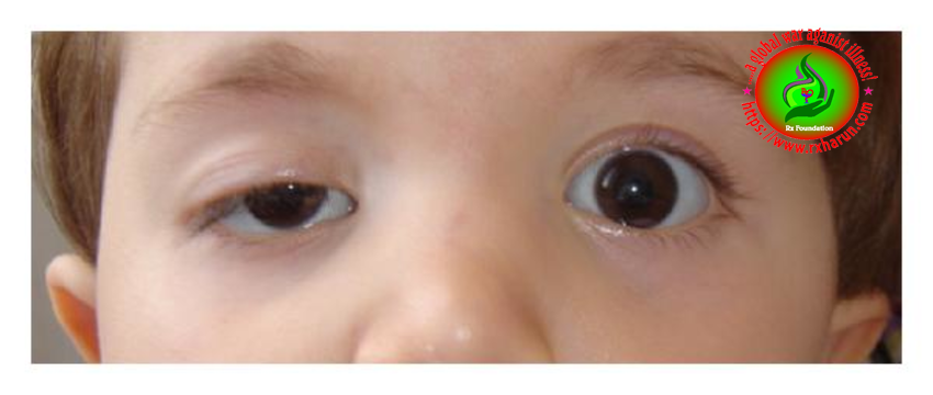 eye-diseases-Amblyopia (Lazy Eye)