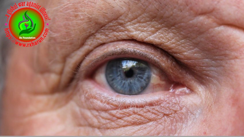 eye diseases -Macular Dystrophy