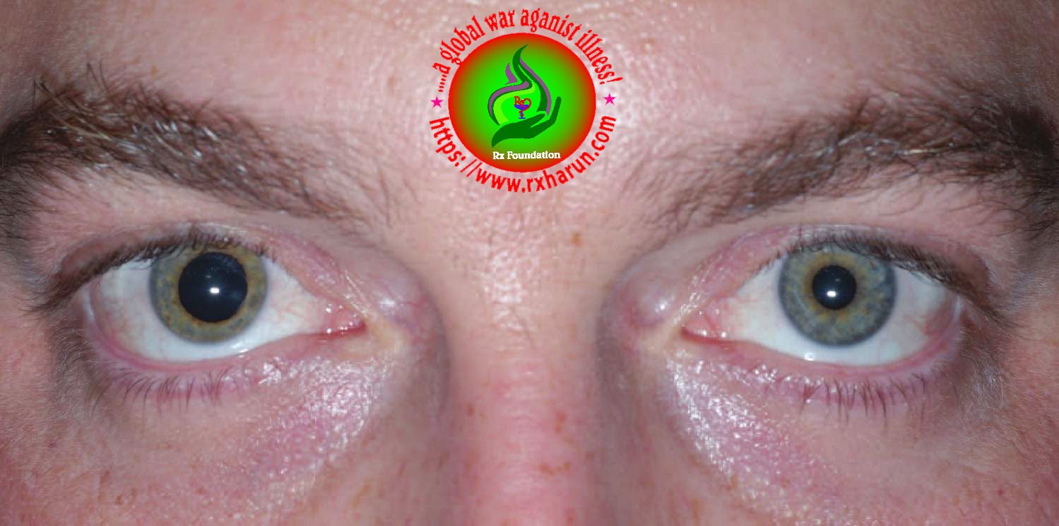 eye-diseases-Anisocoria 