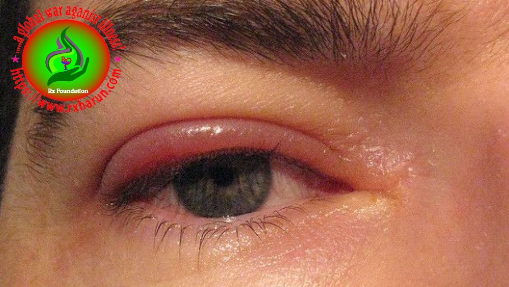 eye diseases, Swollen Eyelids