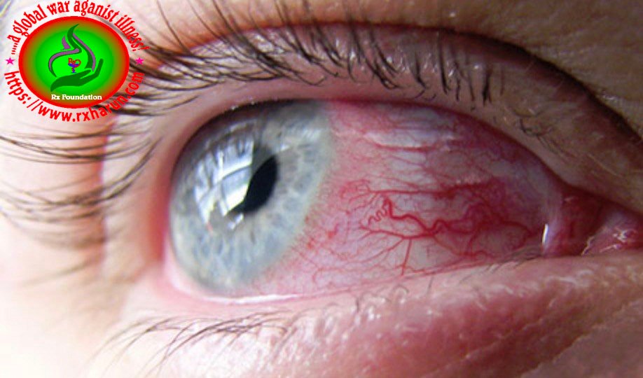 eye diseases ,Burning Eyes