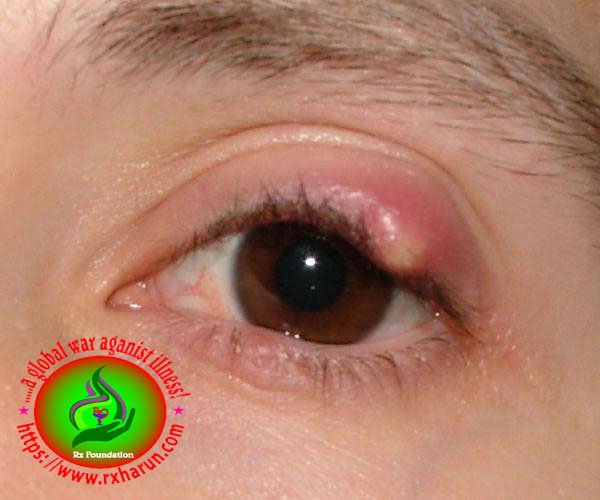 eye diseases ,Chalazion