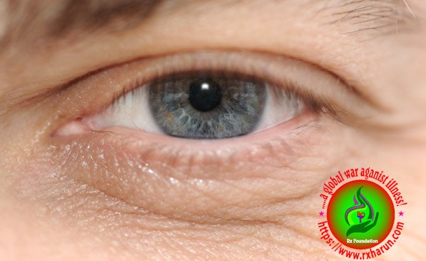 eye diseases Macular Degeneration