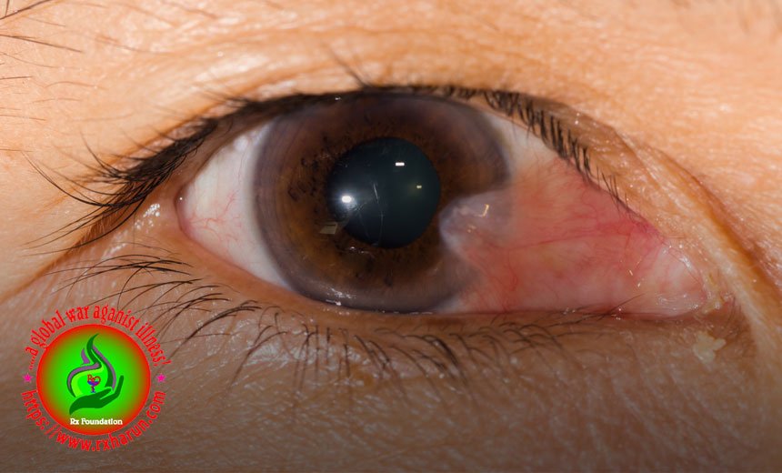 eye diseases-Pterygium
