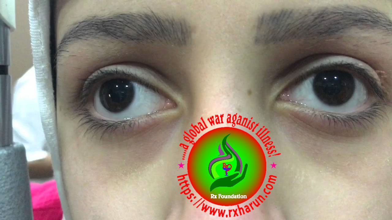 eye diseases,Nystagmus
