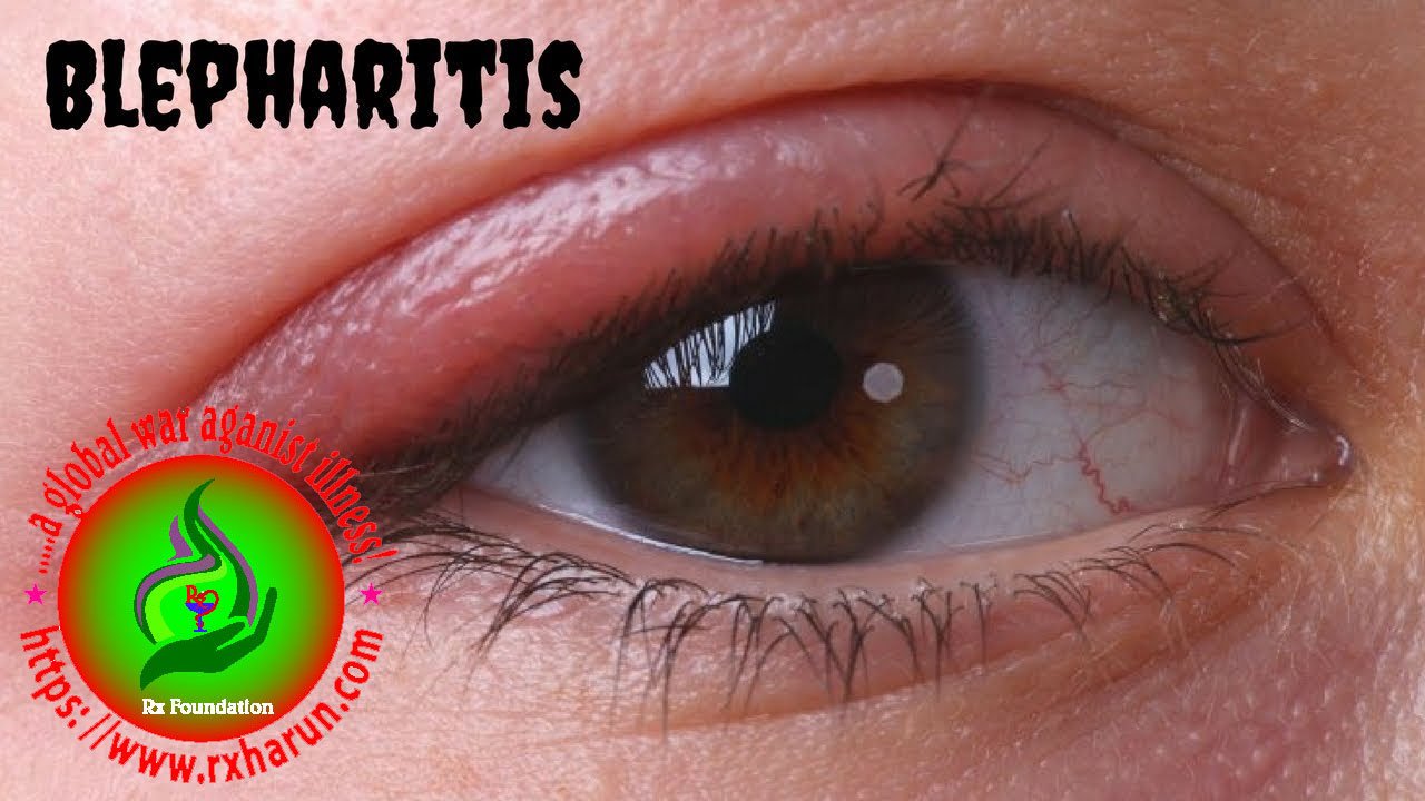 eye diseases Blepharitis
