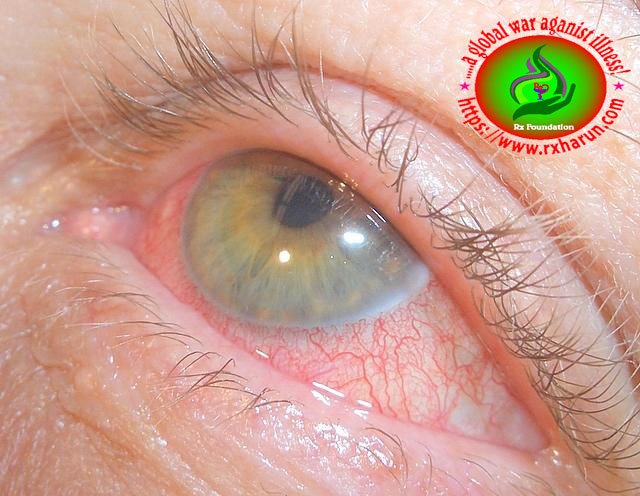 eye diseases, Photophobia