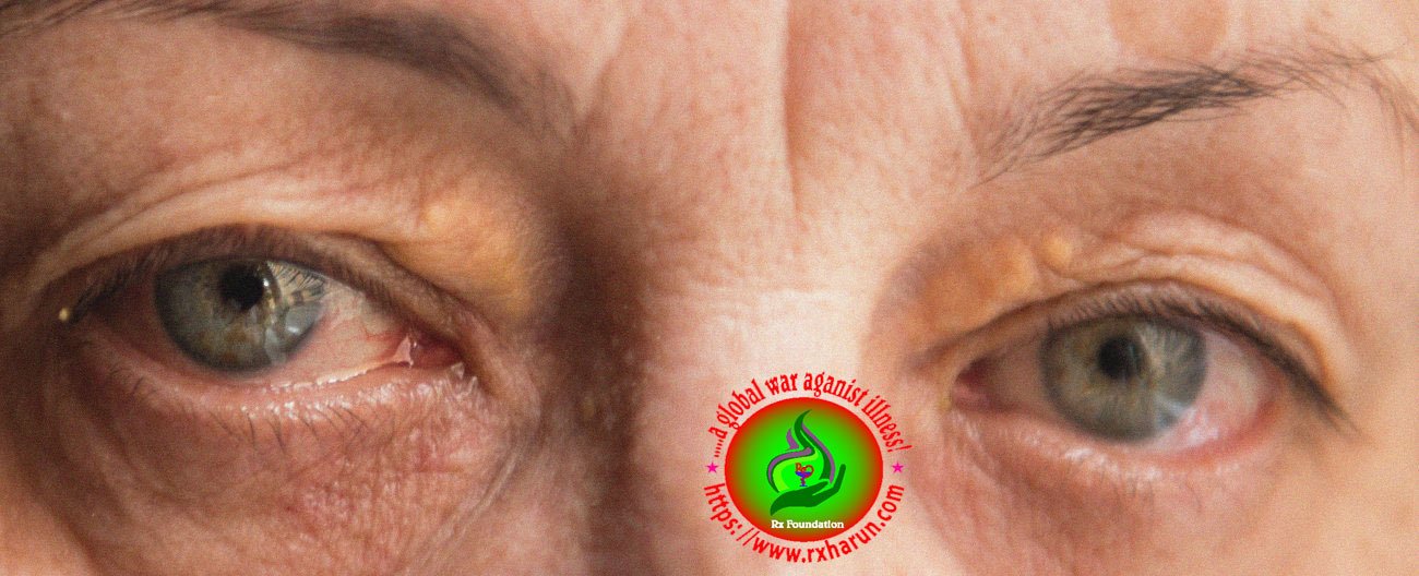 eye diseases-Sjogren's Syndrome