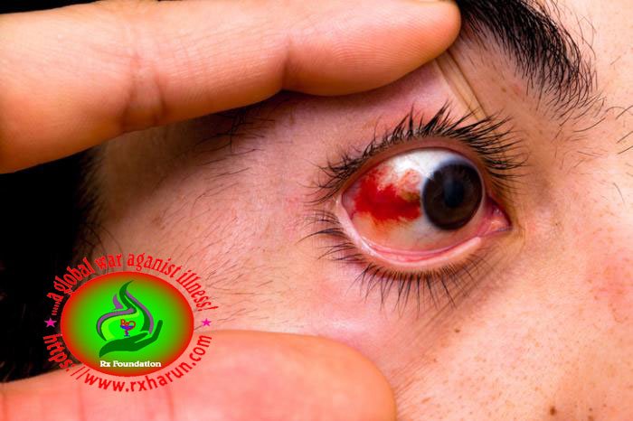 eye diseases Red Eyes