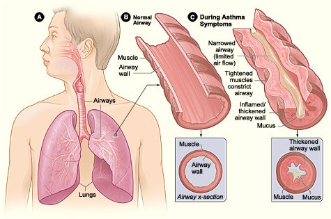 Asthma Latest Research