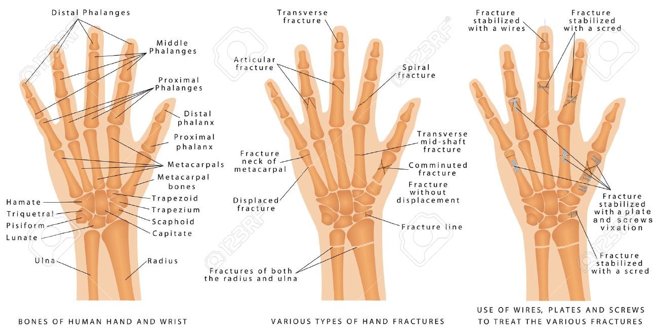 Monteggia Fracture