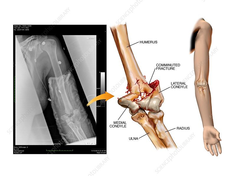 Supracondylar fracture