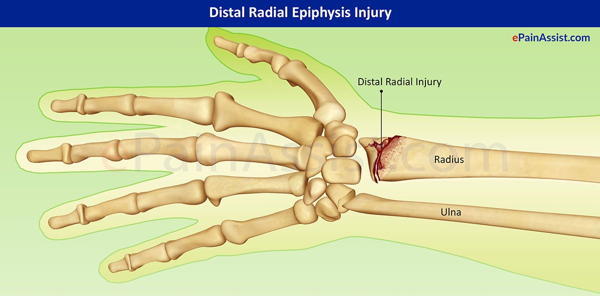 Distal Radius Fractures