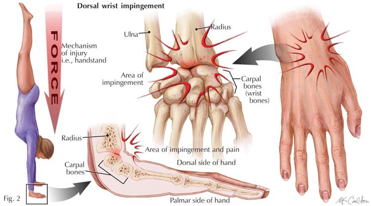 Nightstick Fracture